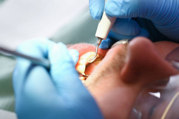 Best Knocked-Out Tooth (Avulsed Tooth) Treatment in Wernersville, PA