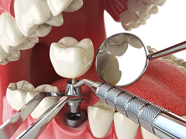 Best Knocked-Out Tooth (Avulsed Tooth) Treatment in Wernersville, PA